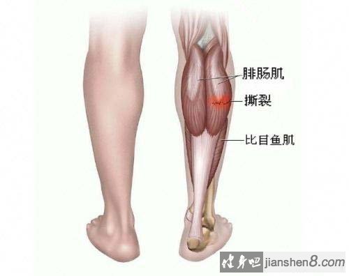 导致腓肠肌肌肉-肌腱连接处的撕裂